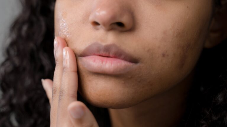 hyperpigmentation